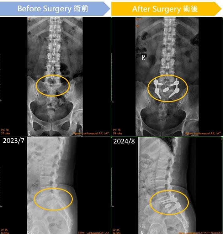 Image:In the left image, the circled area appears cloudy, indicating inflammation; in the right image, the inflammation has disappeared post-surgery.