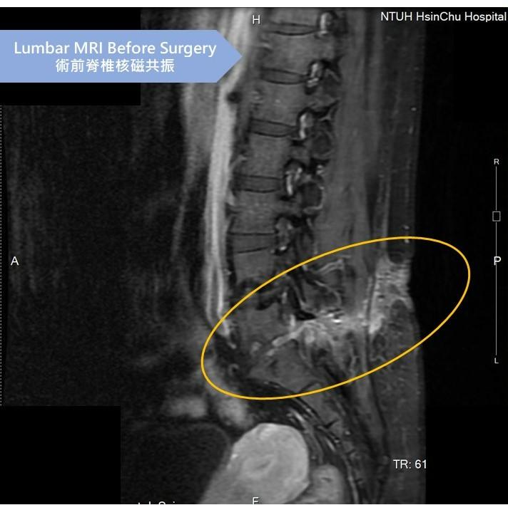 Image:Typically, when a disc is damaged like this, it becomes unstable and requires a fusion surgery for stabilization.